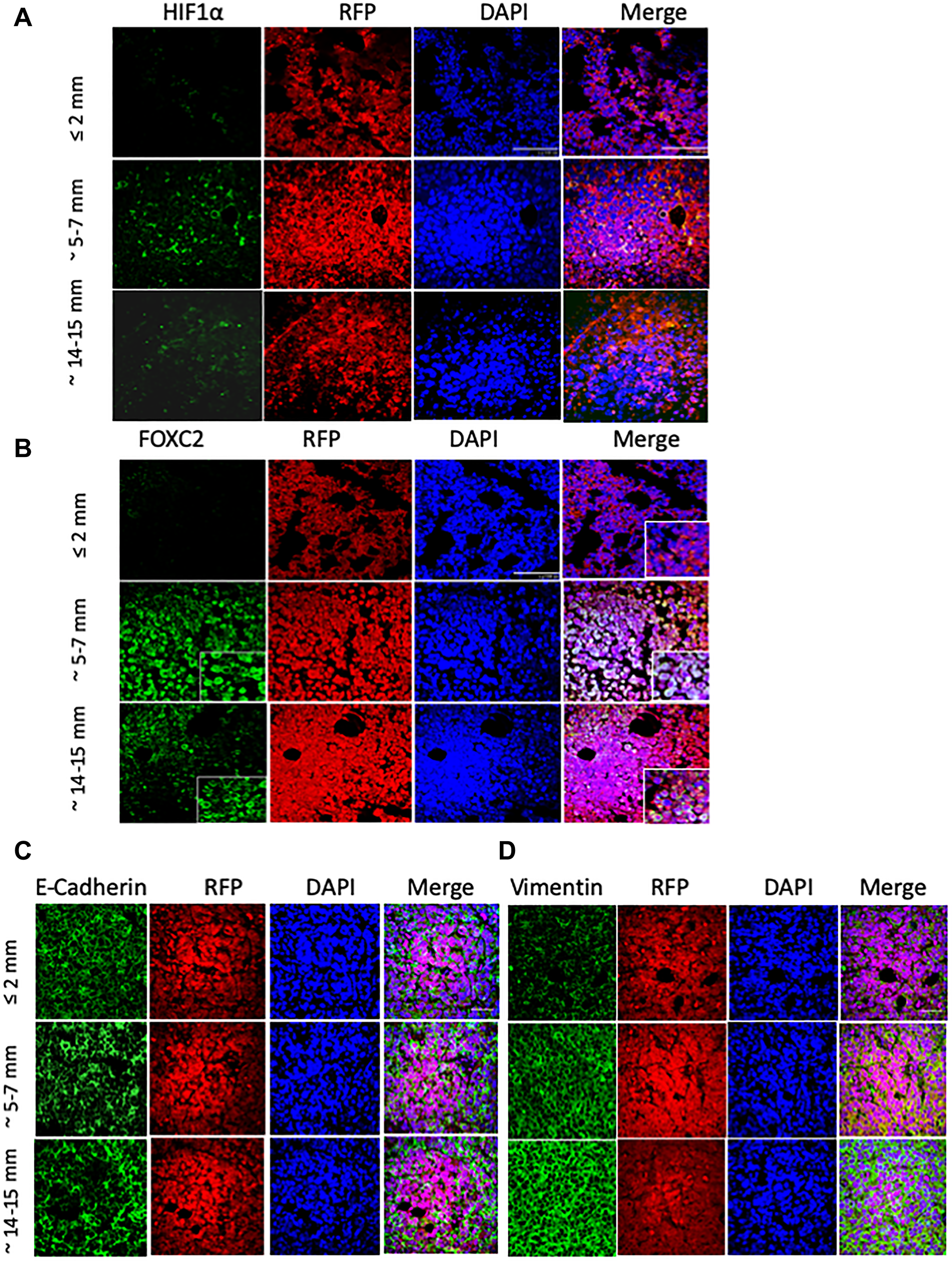 MCF-7 tumor outgrowth is accompanied by increased expression of markers of EMT and hypoxia.
