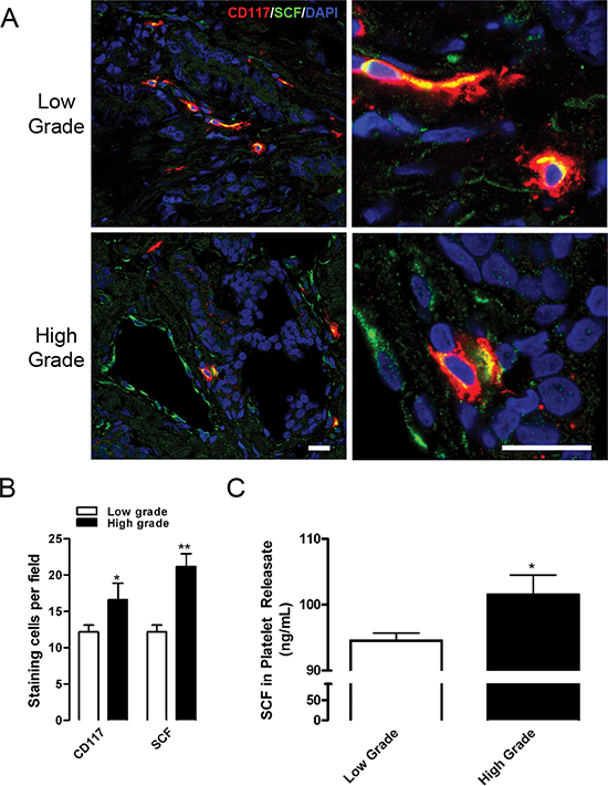 CD117 and SCF are expressed at higher levels in high-grade tumors.