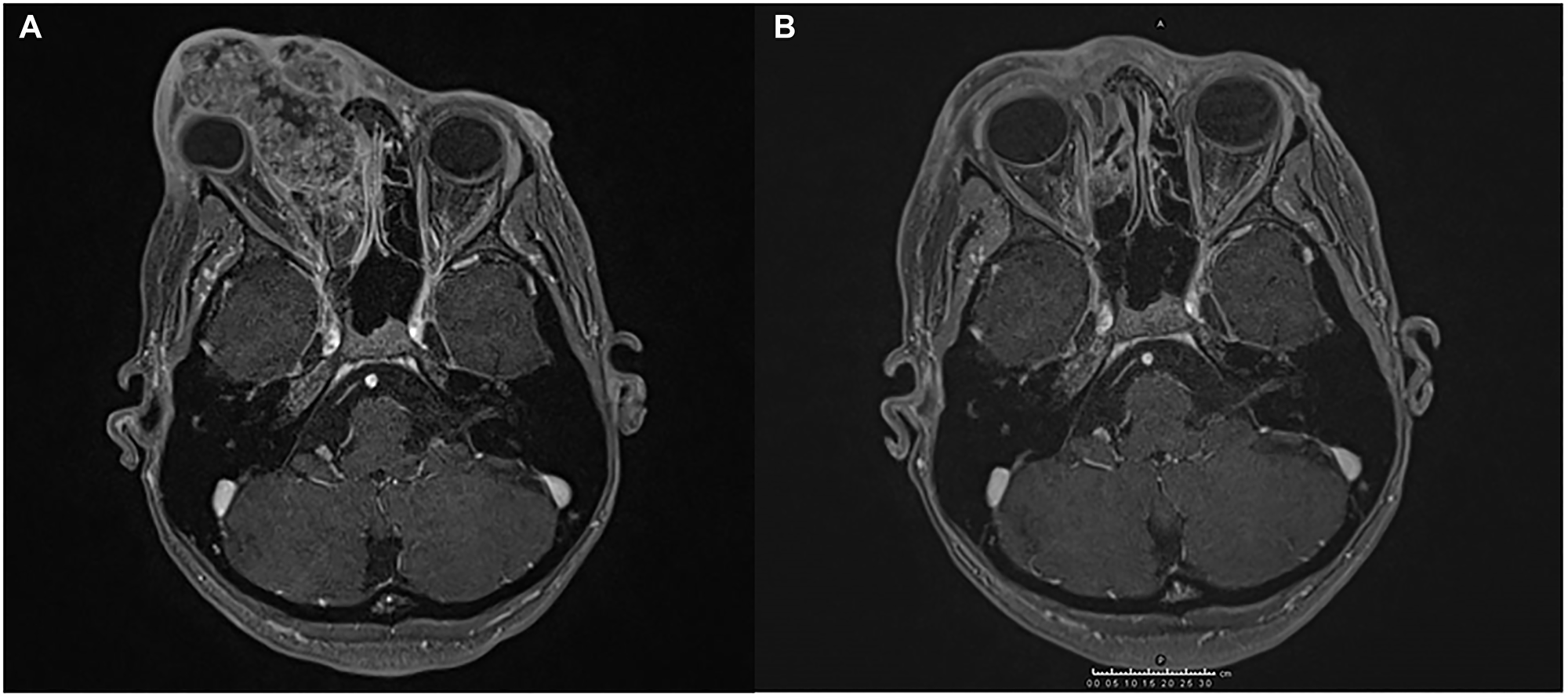 Magnetic resonance imaging (MRI) showing the response of SCC to the treatment administered.