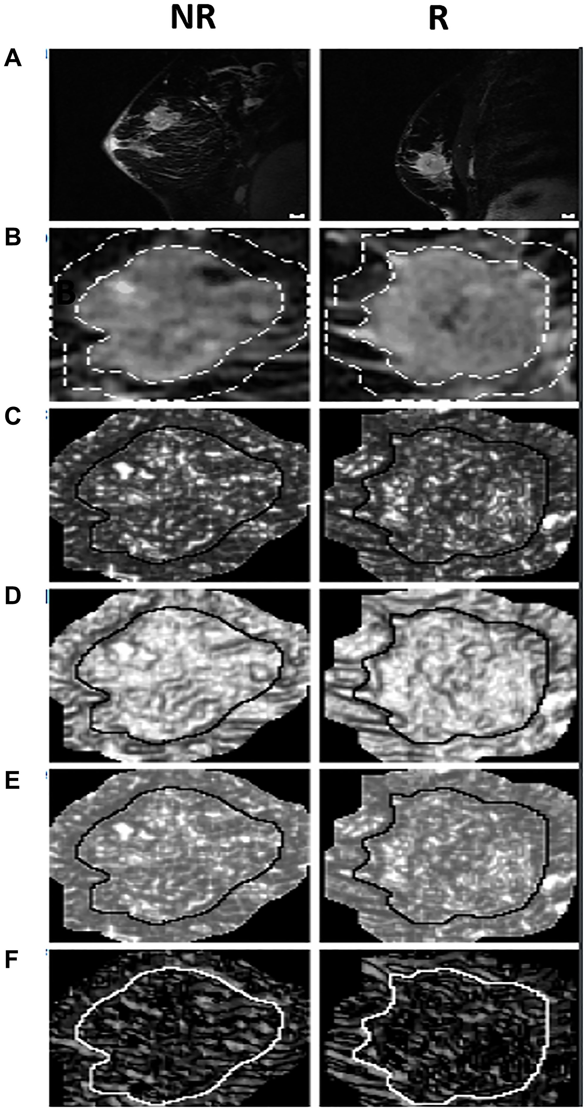 The MRI, quantized tumor ROI, and texture feature images for a typical NR and R.