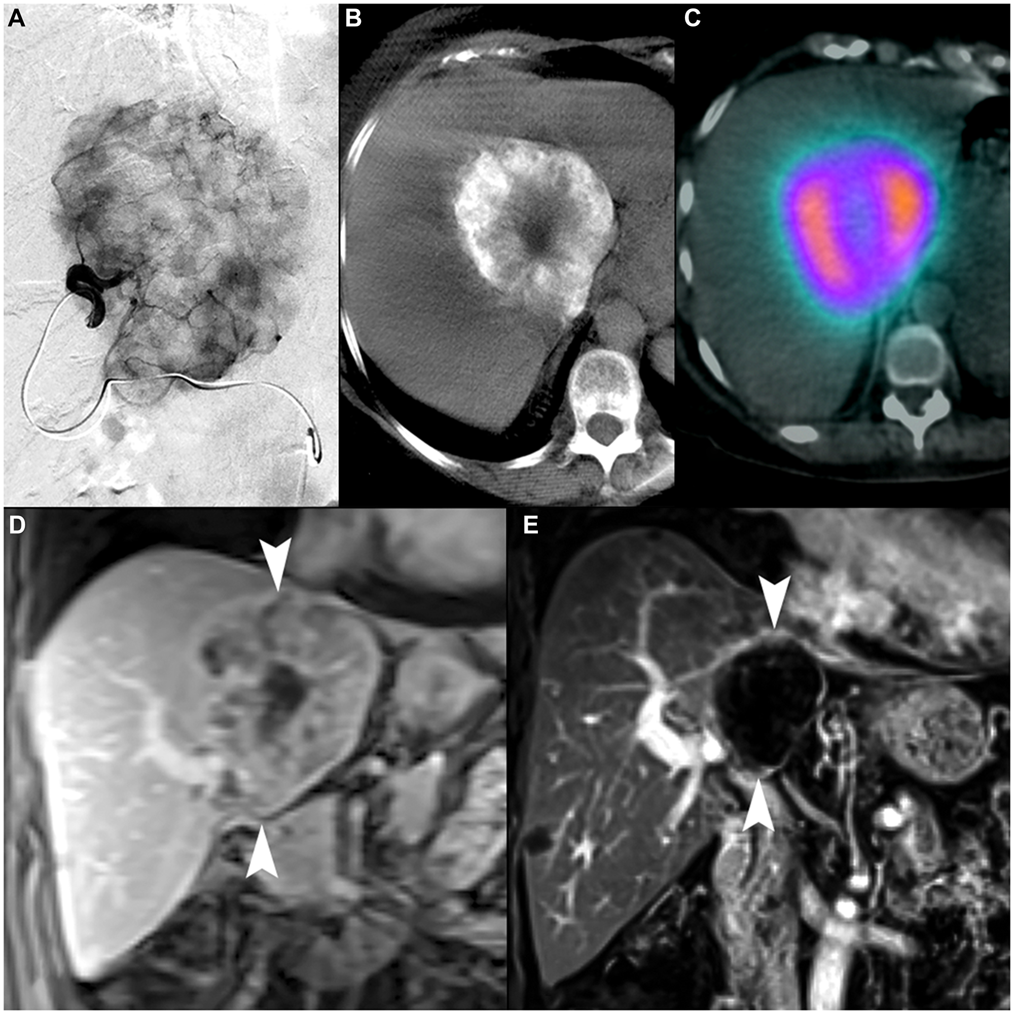 70-year-old female with intrahepatic cholangiocarcinoma.