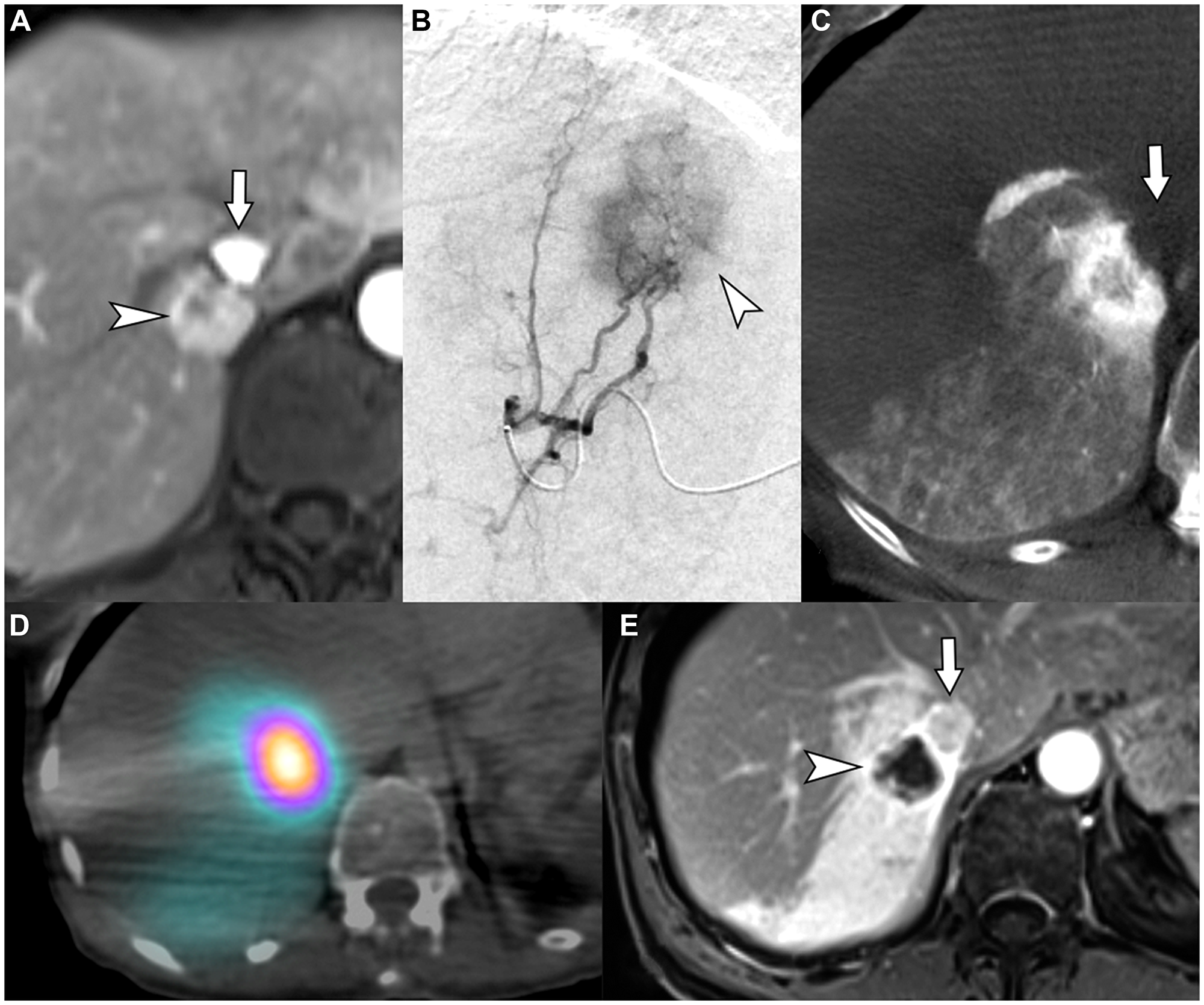 62-year-old female with intrahepatic cholangiocarcinoma in need for liver therapy as a bridge to hepatic resection while being treated for an unrelated second primary adenocarcinoma of lung.