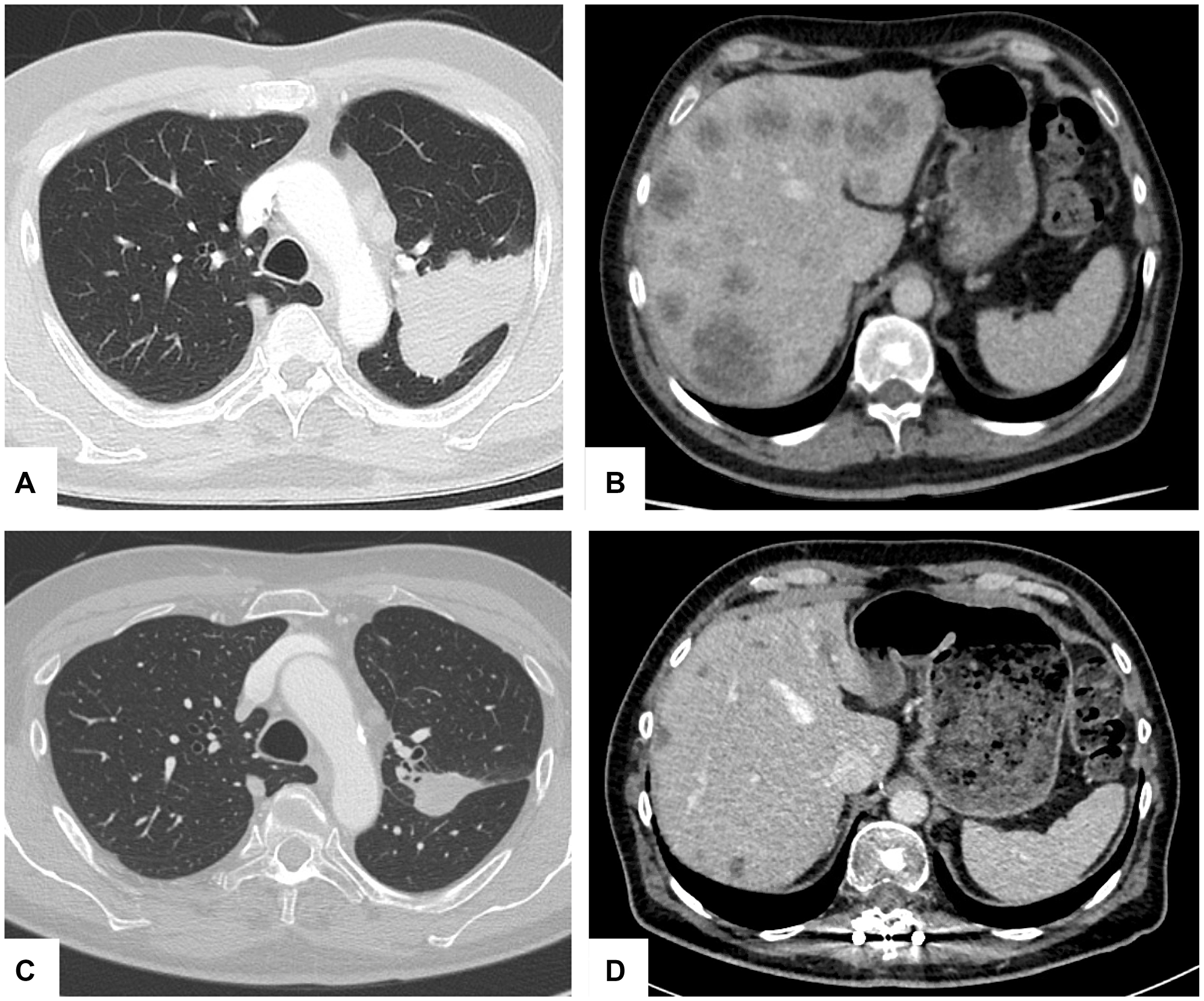 Hepatic and pulmonary tumor response during therapy.