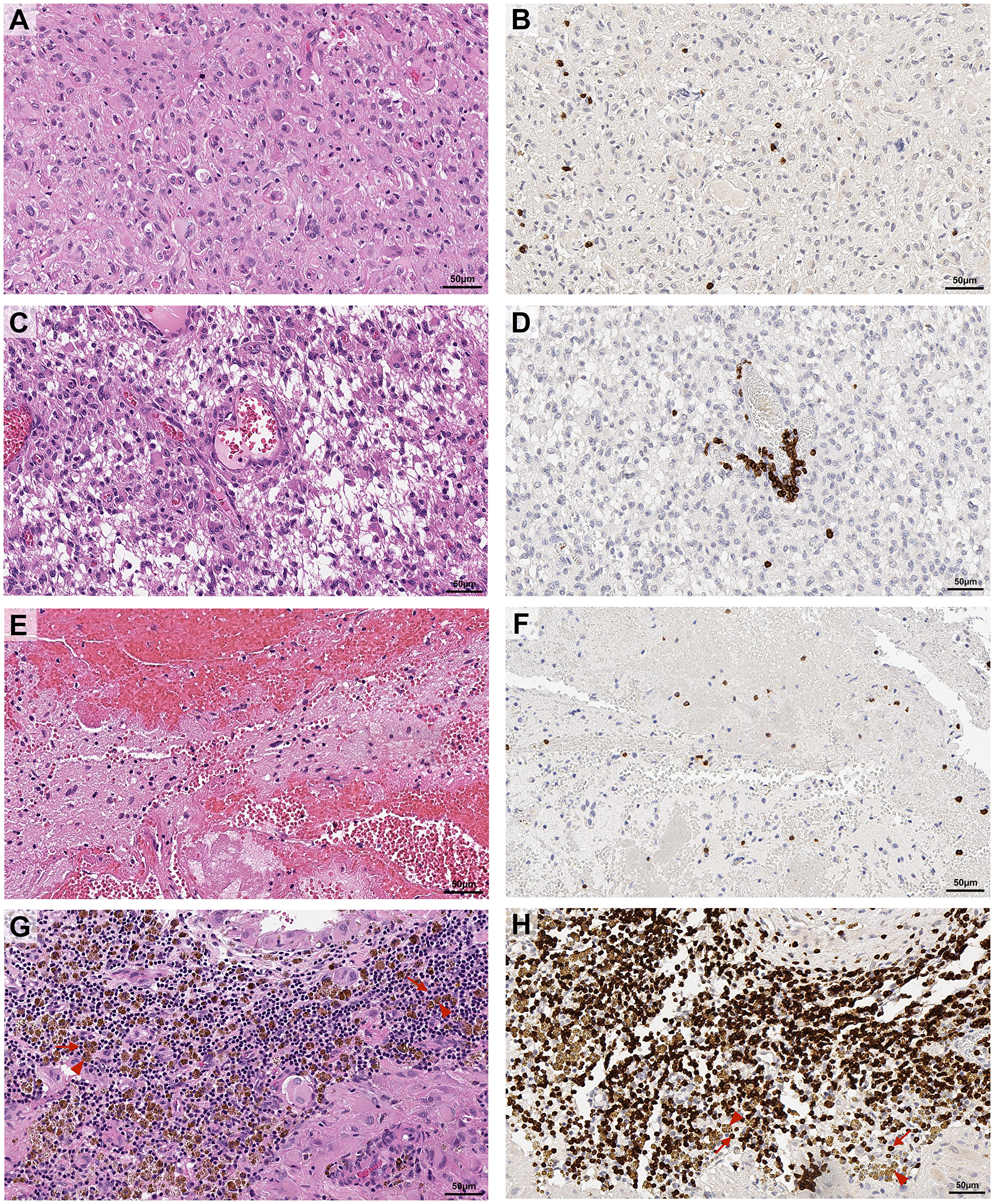 Representative images of topographical localisation of T cells in glioblastoma tumours.