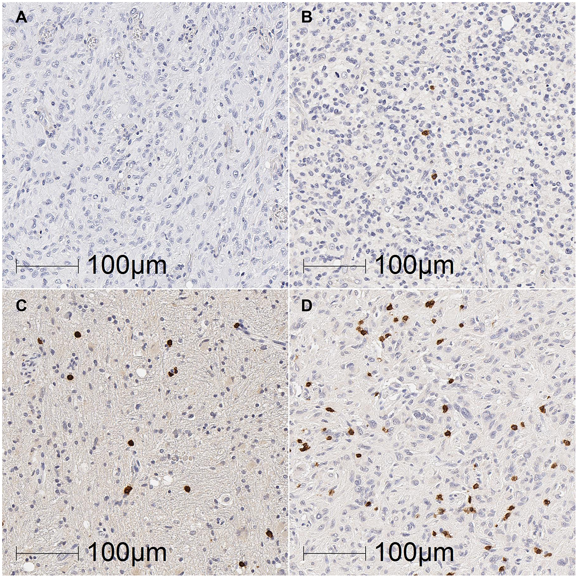 Representative images of TIL density in glioblastoma tumours.