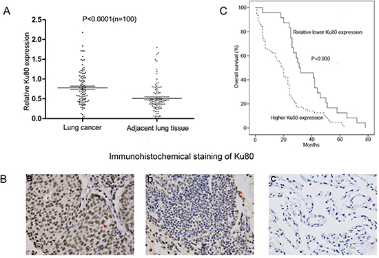 Ku80 is overexpressed in NSCLC tissues and its expression level is associated with lower survival rates.