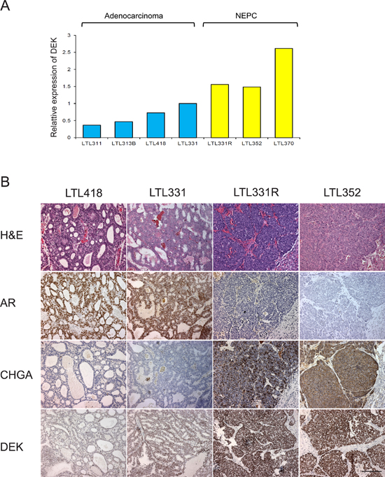 DEK expression in patient-tissue derived xenograft models.