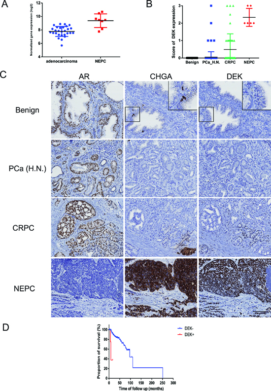 DEK expression in clinical prostate cancer samples.