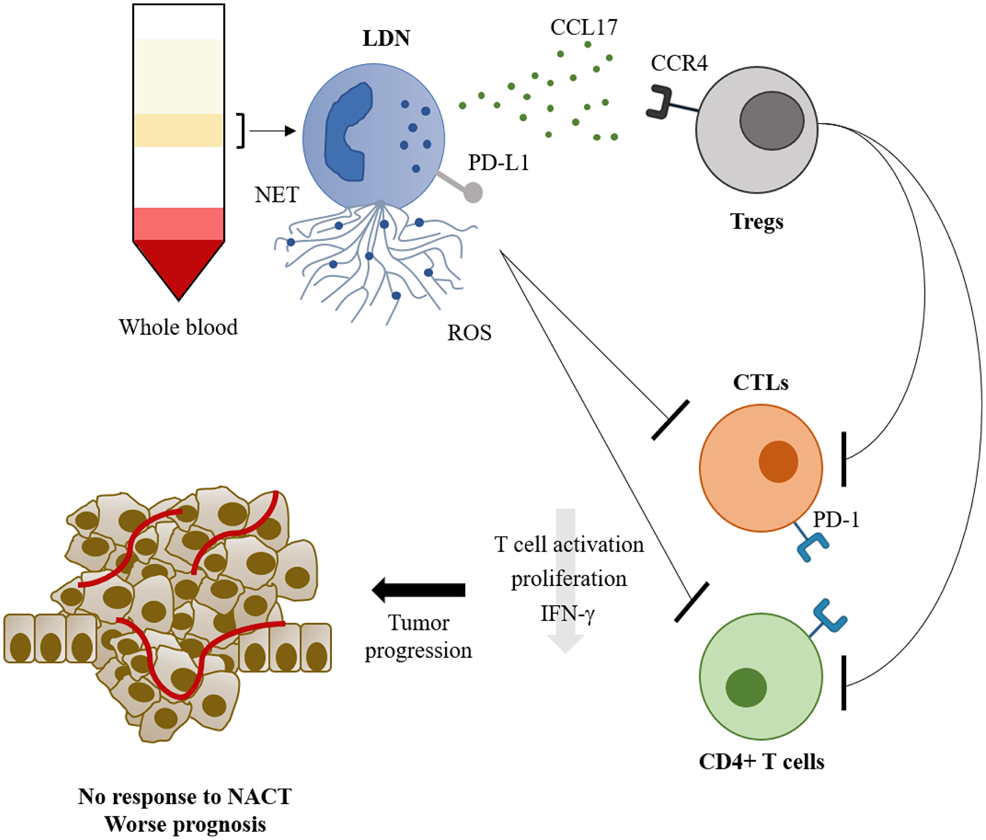 Figure 5: The role of low density neutrophils in breast cancer prognosis and response to neoadjuvant chemotherapy.