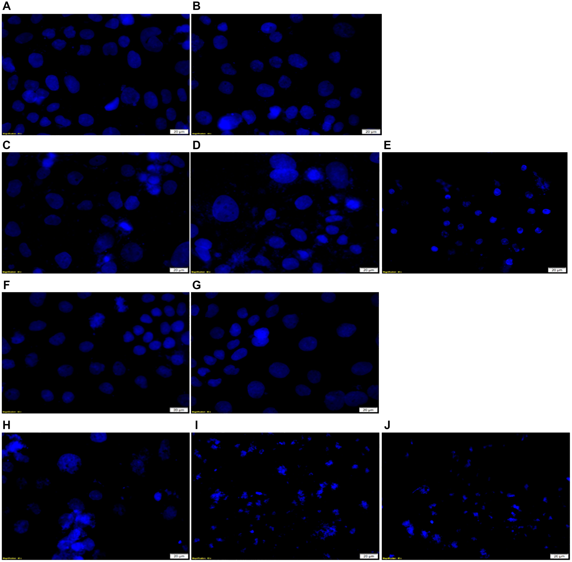 DNA damage Hoechst 33258 stained in vitro CRC cells examination in FNBC PDT response assays with and without CBD treatment.