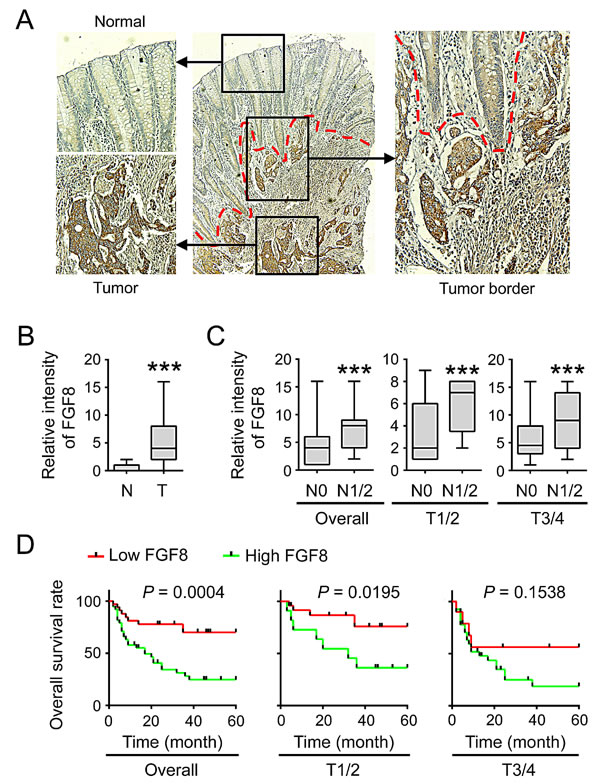 Overexpression of FGF8 correlates with lymph node metastasis and poor prognosis in CRC.