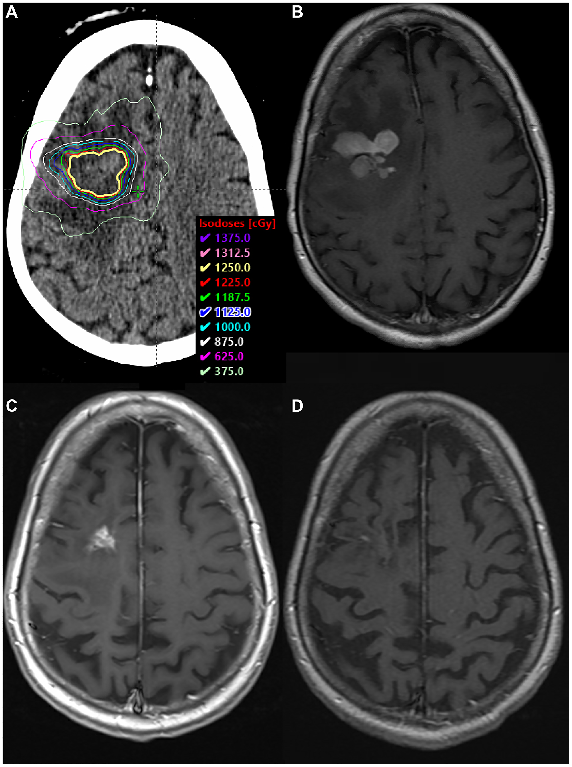 SRS boost treatment plan and MRI scans.