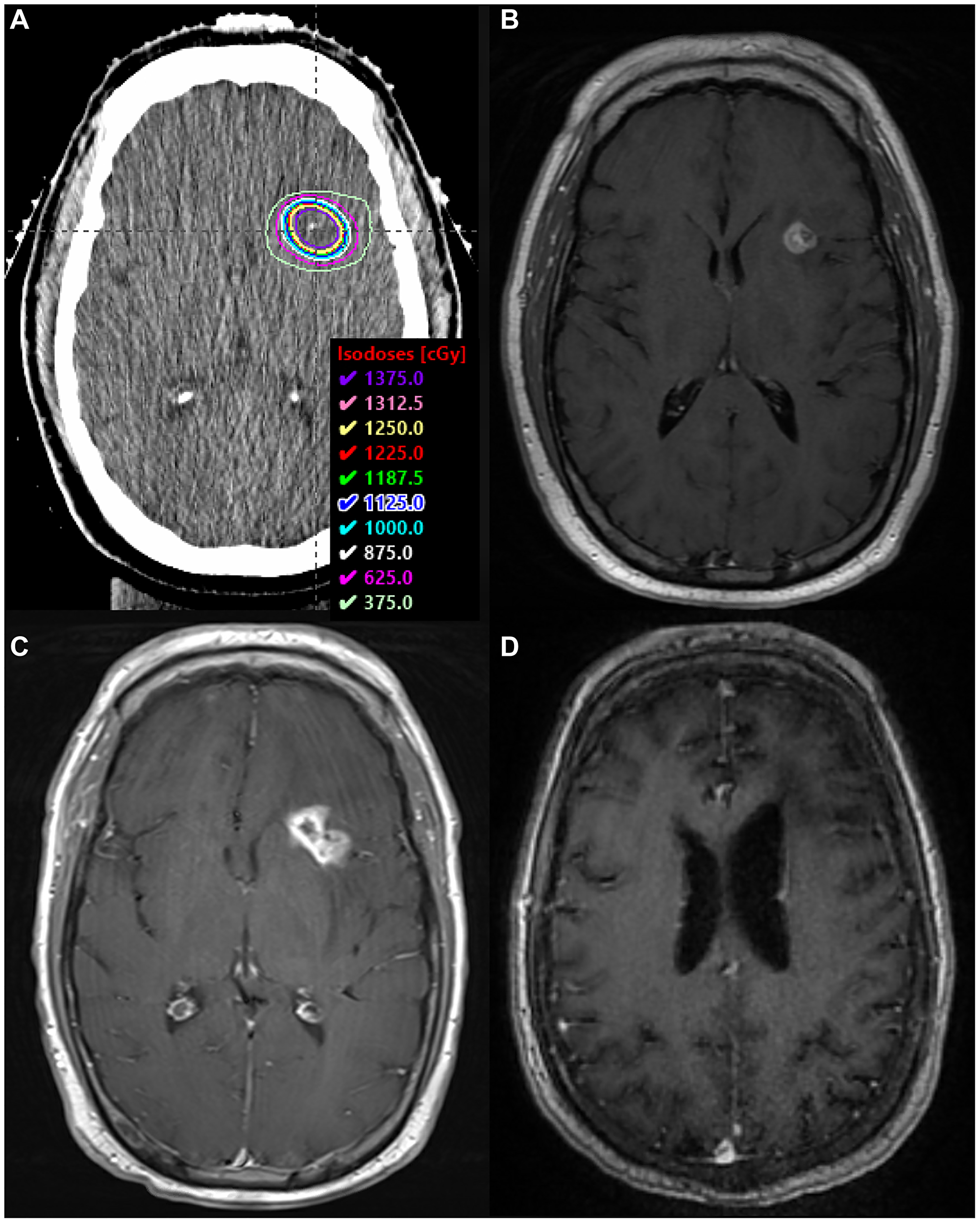 SRS boost treatment plan and MRI scans.