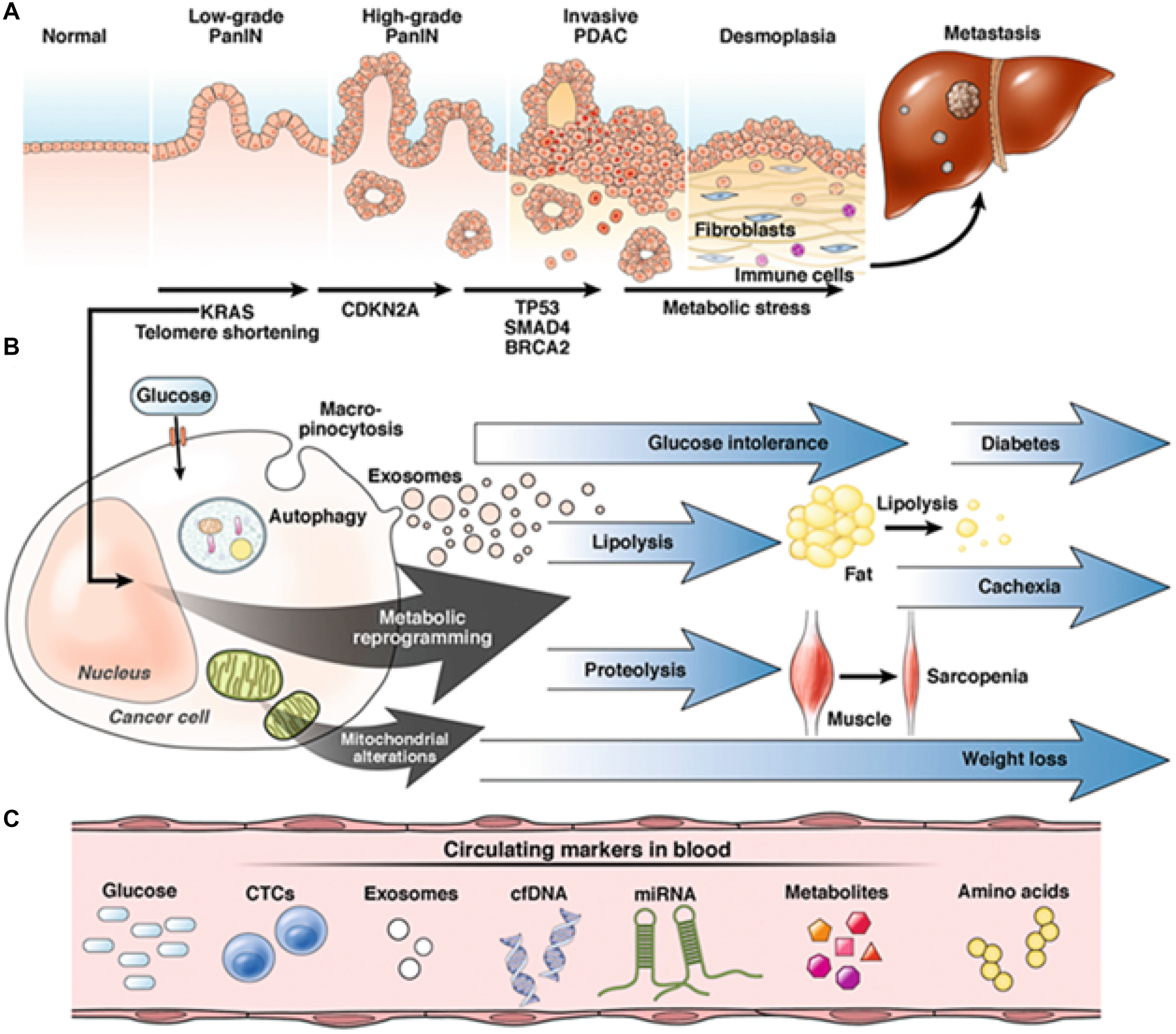 Progression of pancreatic adenocarcinoma (PDAC).