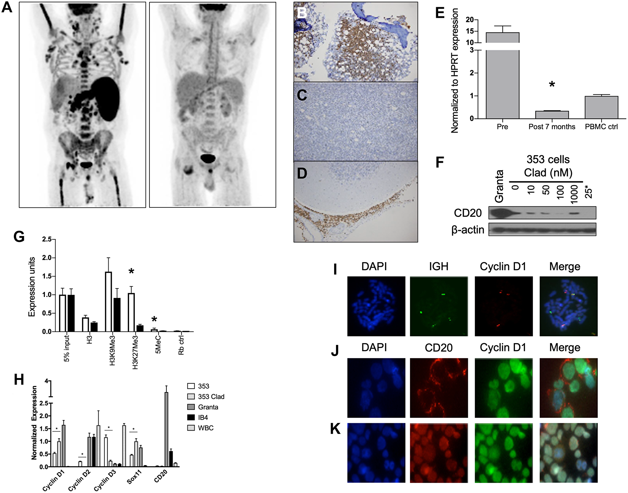 Mechanisms of SCR resistance and characterization of the CD20 negative MCL cell lines 353.