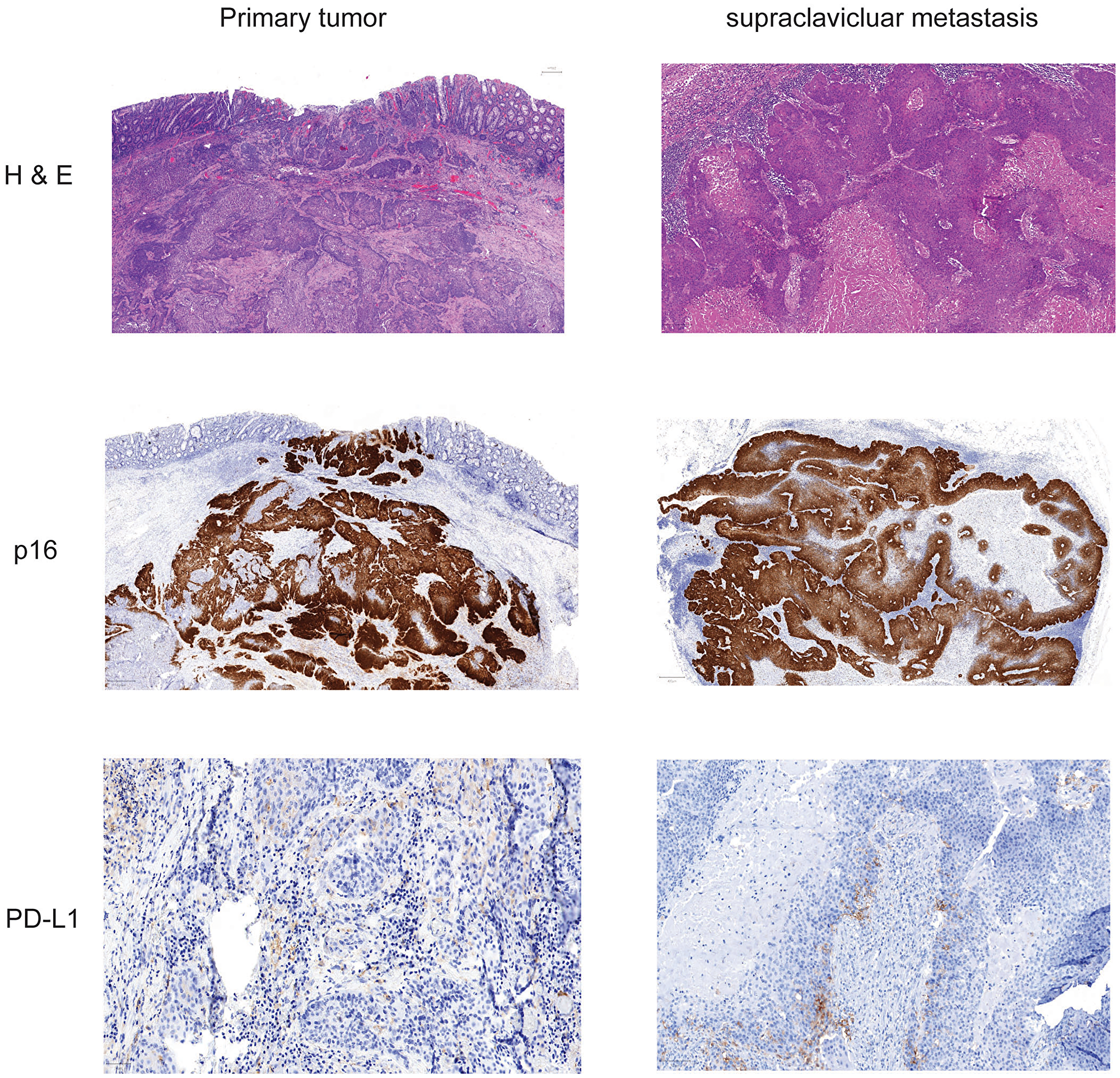 Histochemistry and immunohistochemistry of tumor tissue of primary cancer and lymph node metastasis.