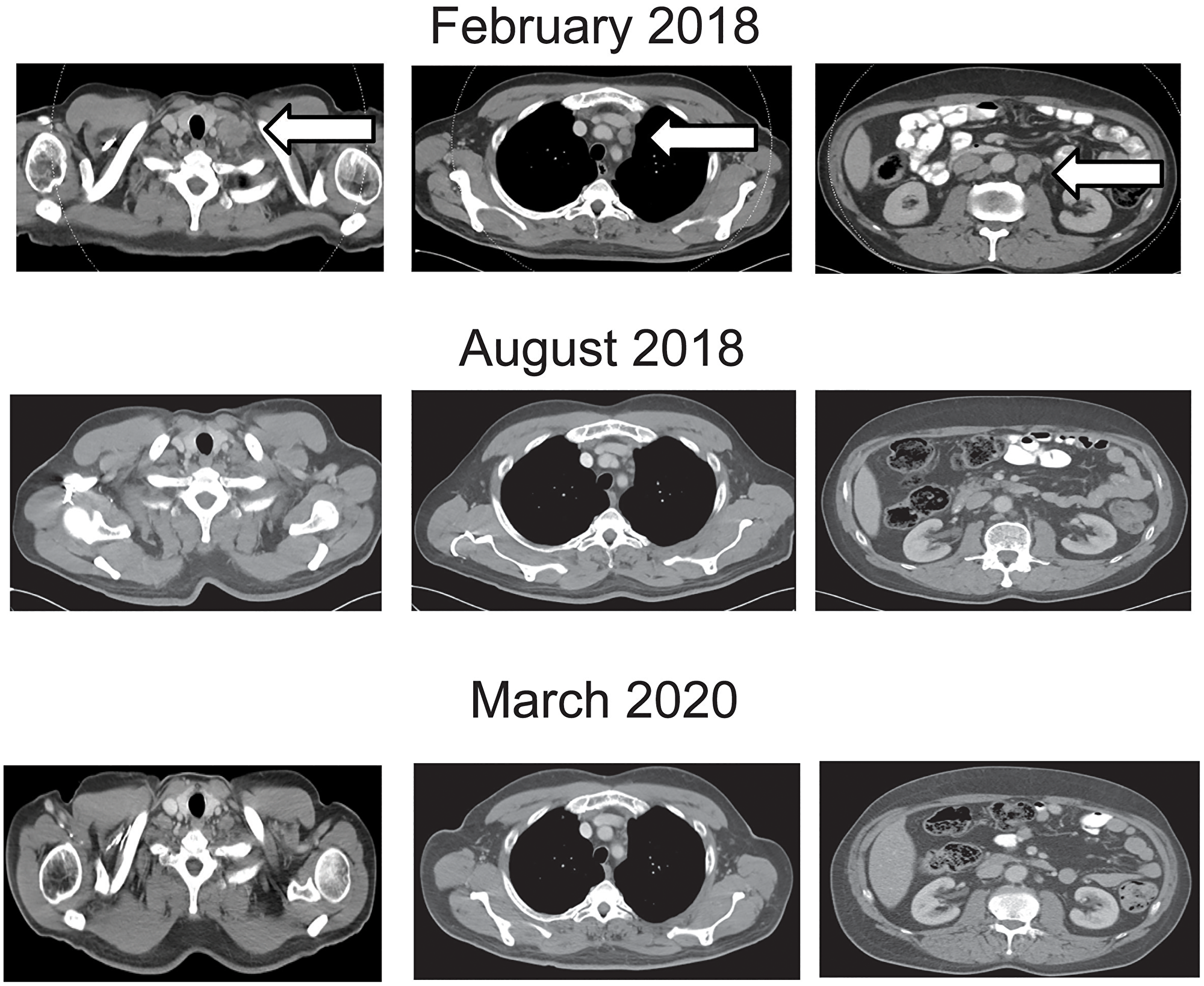 Contrast enhanced computed tomography of the chest and abdomen at beginning, during and at the end of nivolumab treatment.
