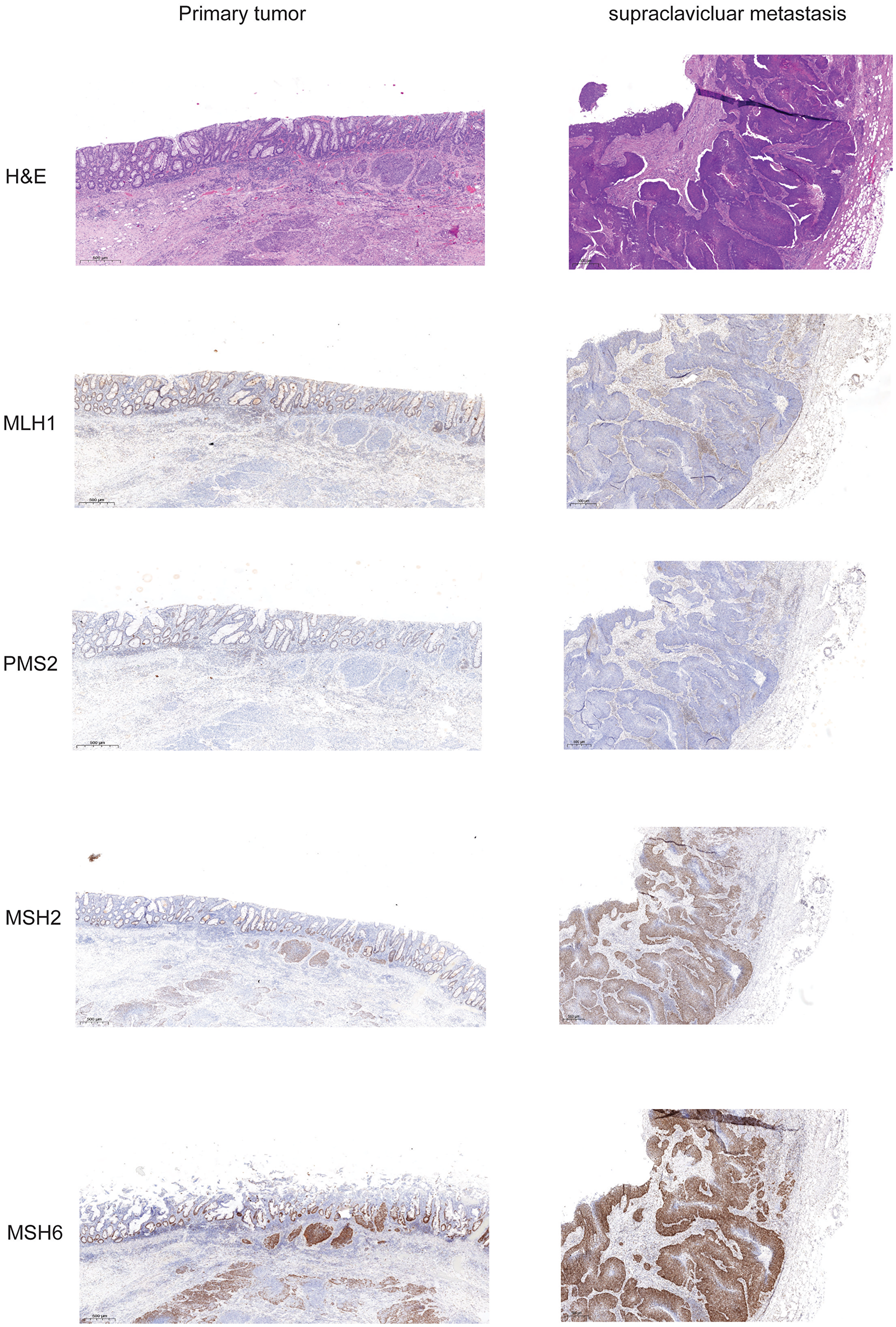 Expression of mismatch repair proteins in primary tumor and supraclavicular metastasis.