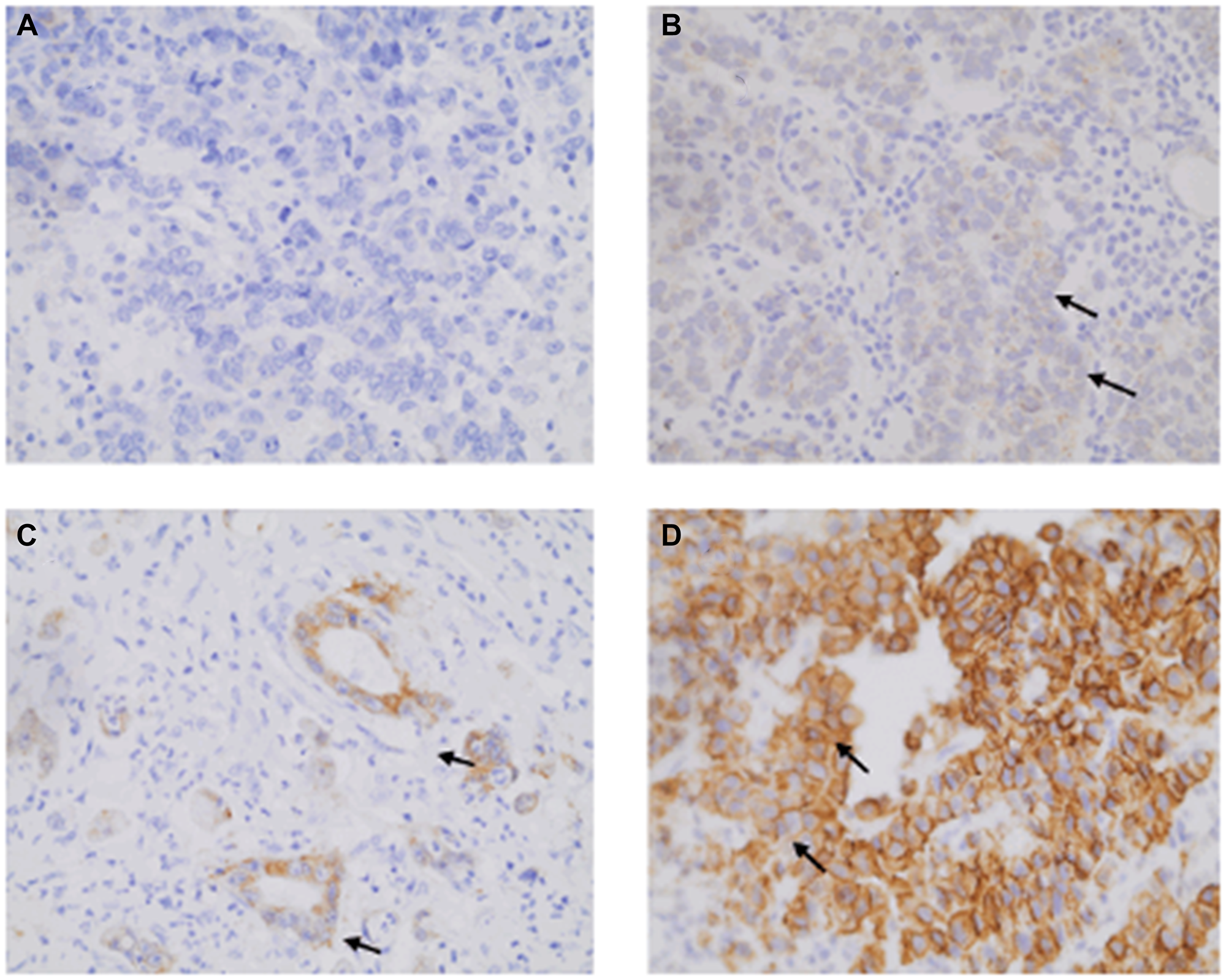 Illustrative HER2 immunohistochemistry labeling observed for gastric adenocarcinoma (GA) patients at 400× magnification.