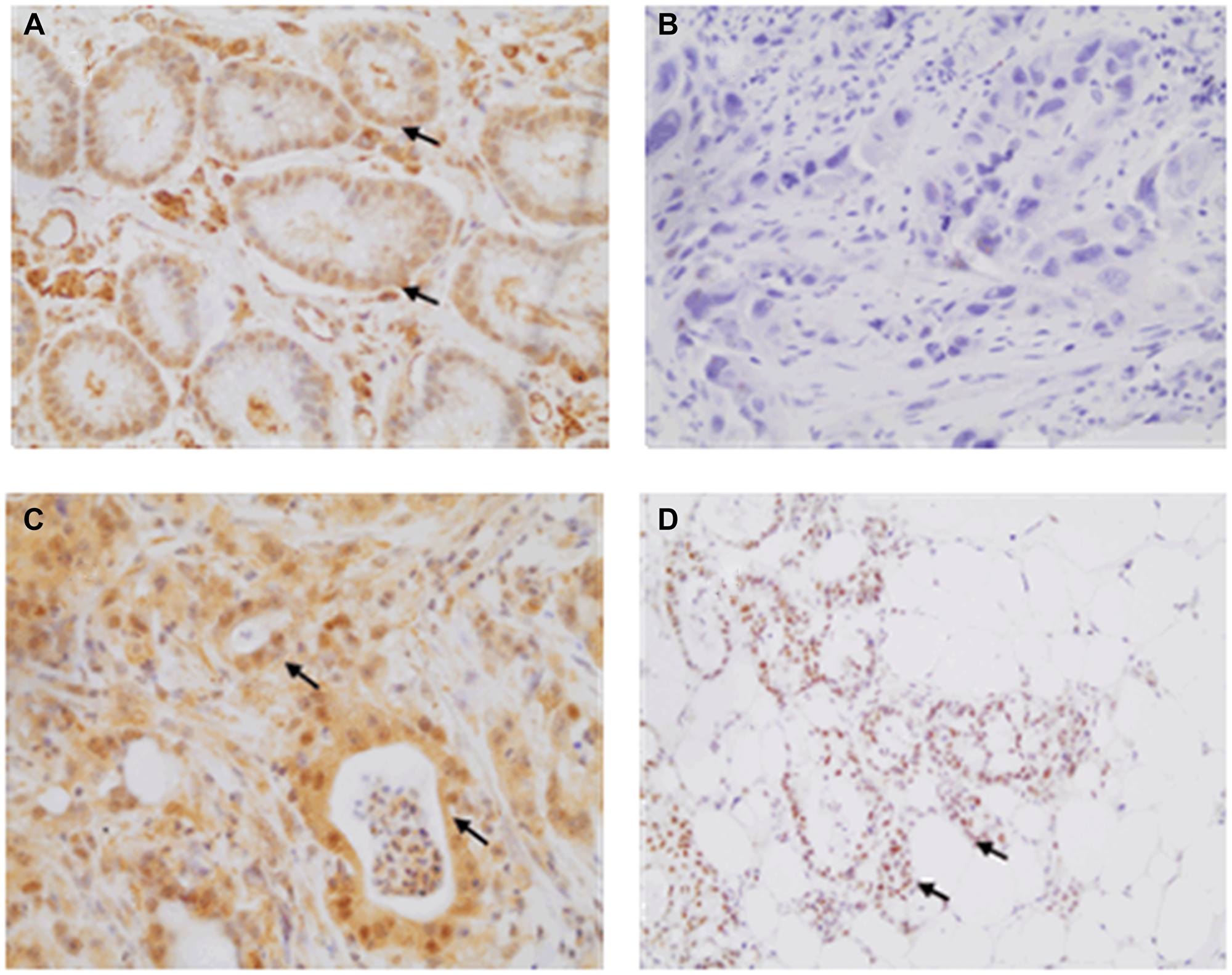 Illustrative HIF-1 immunohistochemistry labeling observed at 400× magnification for gastric samples.