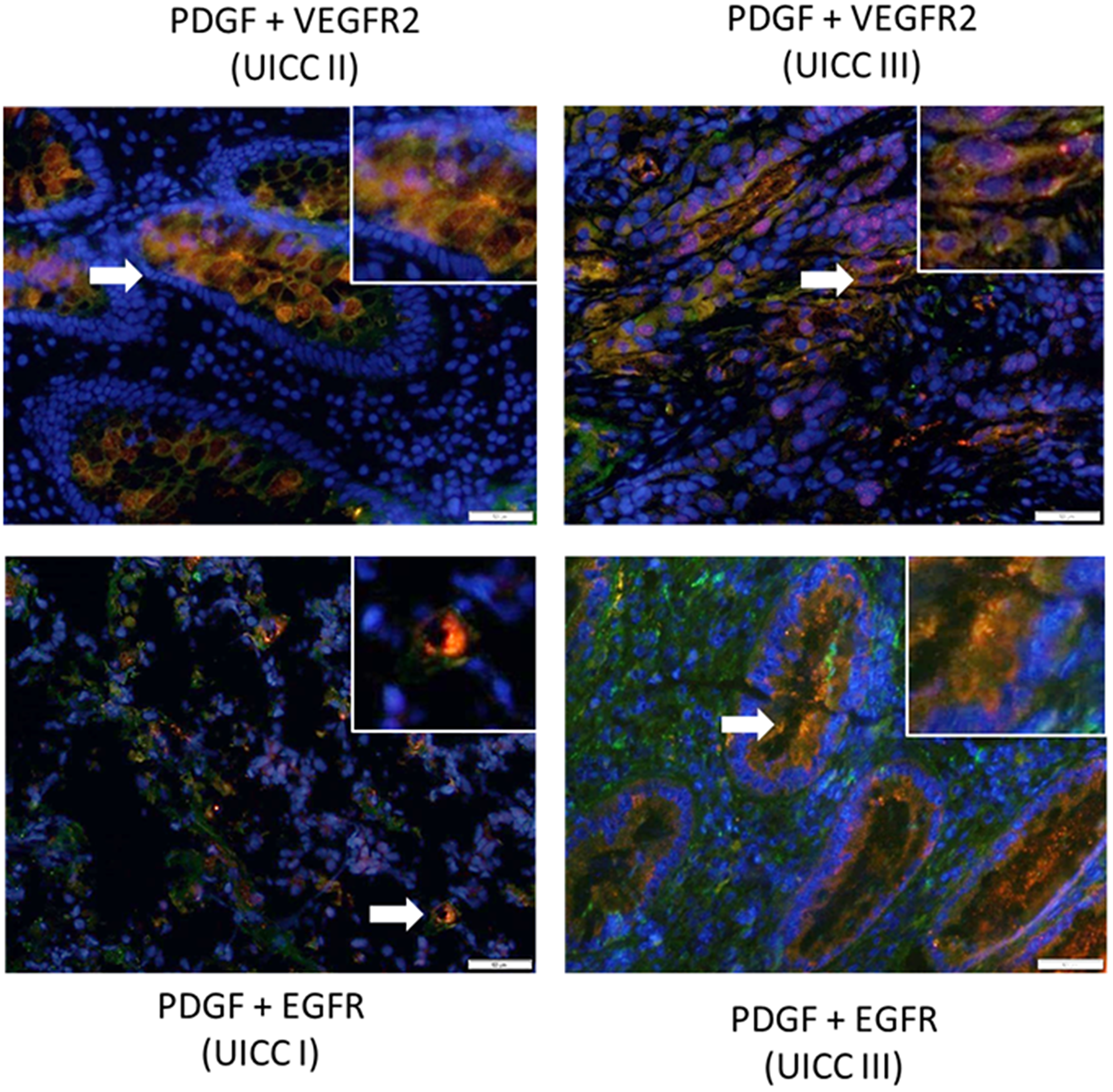 Co-expression of PDGF with VEGFR2 and EGFR in human colon cancer.