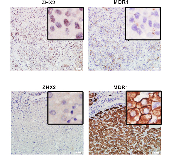ZHX2 expression is inverse correlated to the expression of MDR1 in HCC.