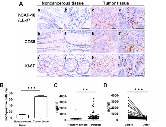 Human colon cancers express cathelicidin, exhibit accumulation of macrophages and show strong tumor proliferation.