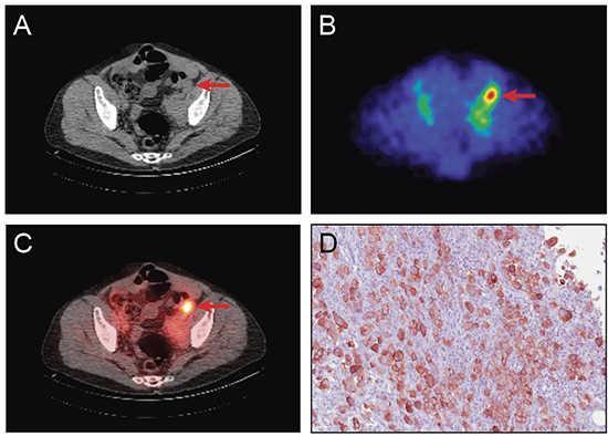 Representative images showing tumor localization of 111In amatuximab and tumor expression of mesothelin in a 53 year old man with metastatic mesothelioma.