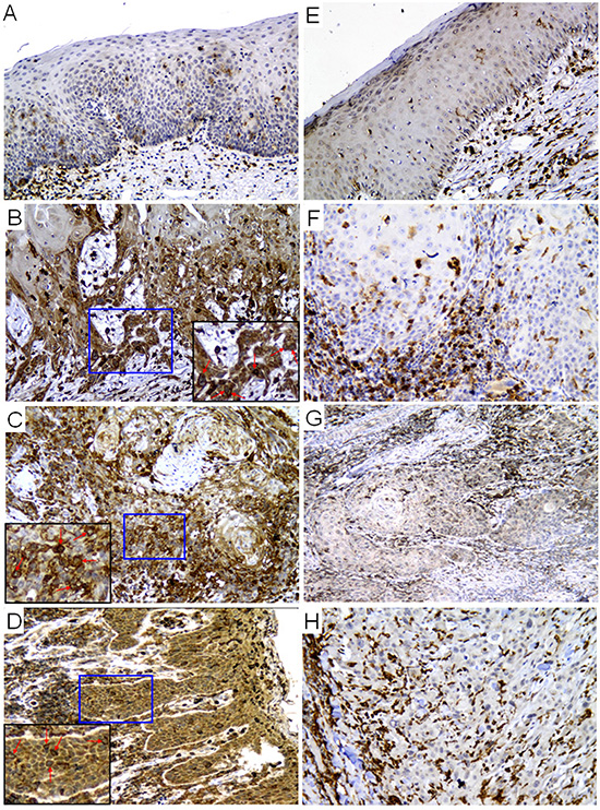 Expression of p22phox was significantly higher in CDDP-resistant than CDDP-sensitive OSCC tissues.