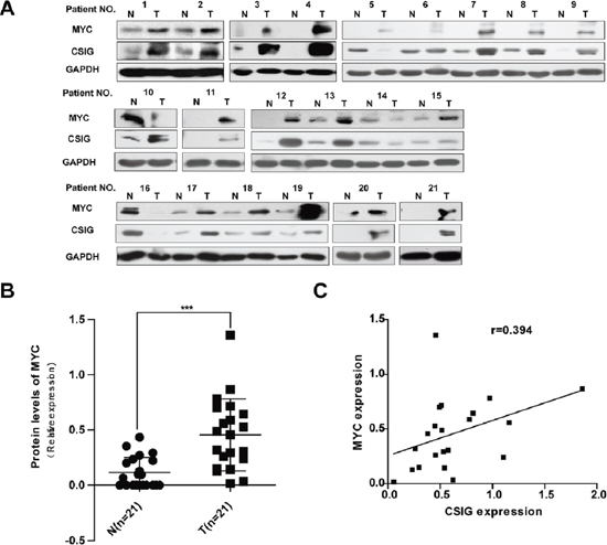 Increased expression of CSIG in HCC was associated with MYC protein.