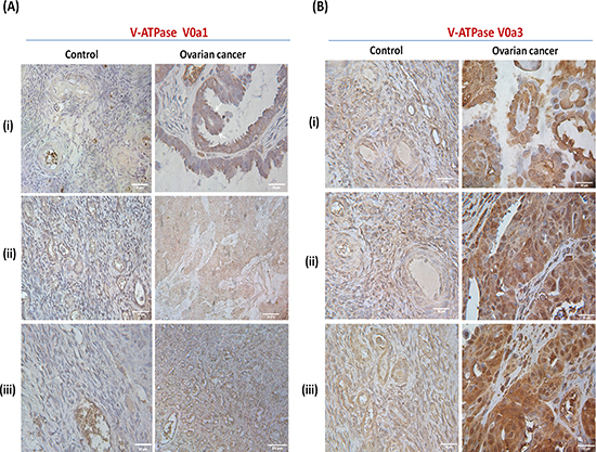Expression pattern of V-ATPase V0a1 and V0a3 isoforms in ovarian cancer tissues.