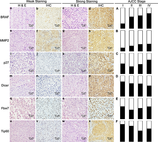 Expression levels of 6 biomarkers are changed across melanoma AJCC Stages.