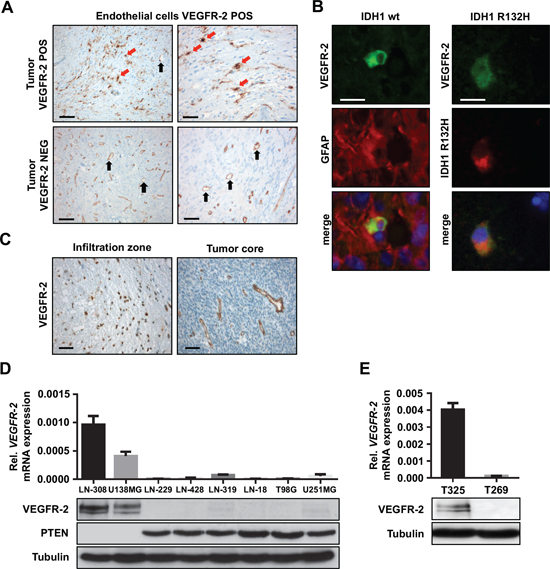 VEGFR-2 is expressed by tumor cells in a subset of glioblastoma.