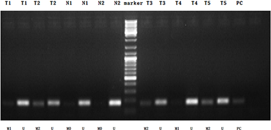 MSP detection of ZNF545 promoter methylation in different GC tissues and normal gastric mucosal tissues.
