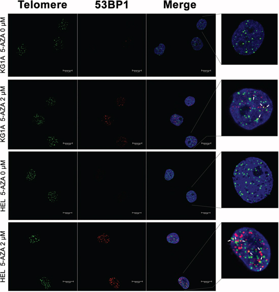 DNA damage and telomere dysfunction mediated by 5-AZA in AML cells.