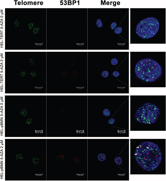 Attenuation of telomere dysfunction and DNA damage by ectopic TERT expression in 5-AZA-treated HEL cells.