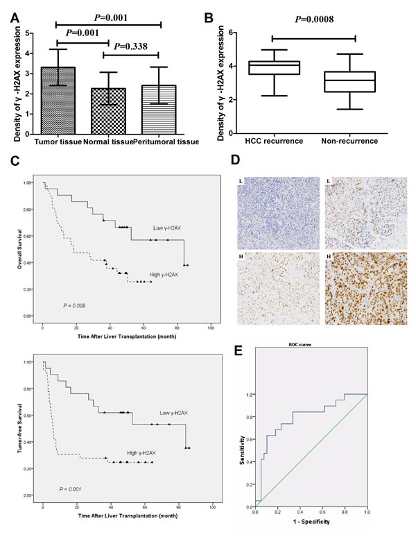 Increased levels of &#x3b3;-H2AX indicate worsening prognosis and recurrence/metastasis of HCC.
