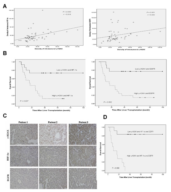 Combined &#x3b3;-H2AX, HIF-1&#x3b1; and EGFR has better prognostic value for HCC after LT.