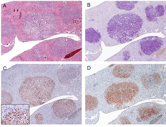 Expression of ectopically injected genes in SKP2/N-RasV12 mice.