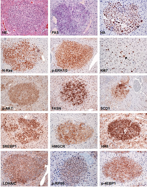 Tumors from SKP2/N-RasV12 mice exhibit strong upregulation of Ras/MAPK and AKT/mTOR pathways.