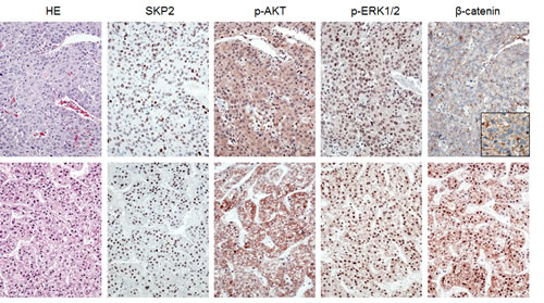 Immunohistochemical patterns of SKP2, activated/phosphorylated AKT (p-AKT), activated/phosphorylated ERK1/2 (p-ERK1/2), and &#x3b2;-catenin proteins in human hepatocellular carcinoma (HCC).