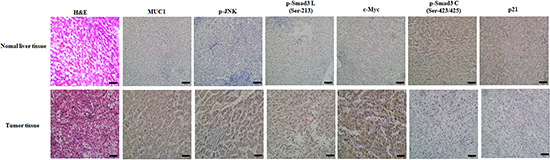 The expression of MUC1 is consistent with that of the pSmad3L/c-Myc pathway but inverse to that of the pSmad3C/p21WAF1 pathway in tumor tissues from HCC patients.