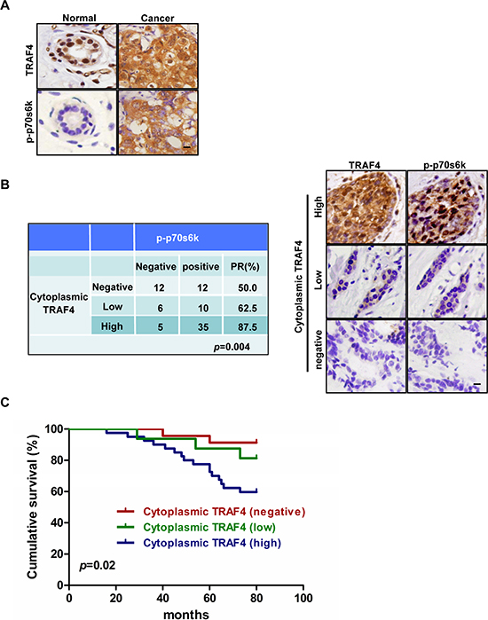 TRAF4 cytoplasmic expression correlates with activation of p70s6k and poor survival in breast cancer patients.