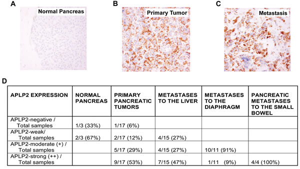 APLP2 expression is elevated in human pancreatic tumor metastases.