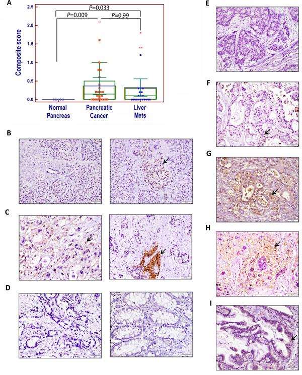 Immunohistochemical analysis of APLP2 protein expression in human pancreatic tissues, primary pancreatic cancer tissues, and patient-matched metastatic lesions in the liver and lung.