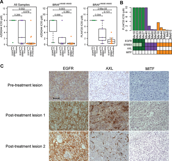 Identification of the EGFRHIGH/ERBB3LOW-Invasive melanoma subtype as intrinsically resistant to BRAFi.