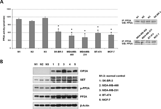 The tumor suppressor PP2A is inhibited in breast cancer cell lines.