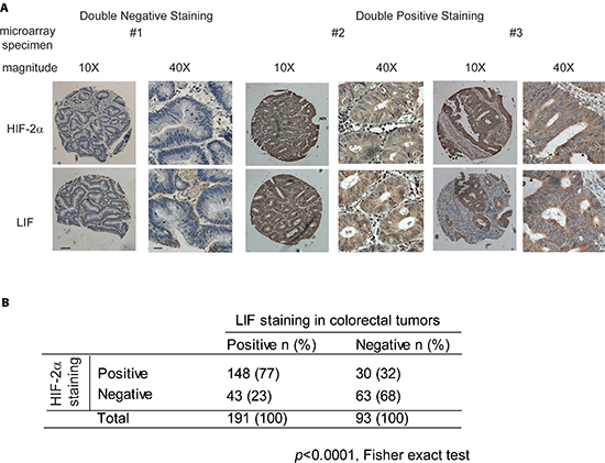 HIF-2&#x03B1; overexpression is associated with LIF overexpression in human colorectal cancer specimens.