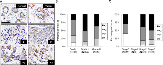 C1GALT1 is frequently overexpressed in breast tumor tissues and correlates with histological grade and stage.