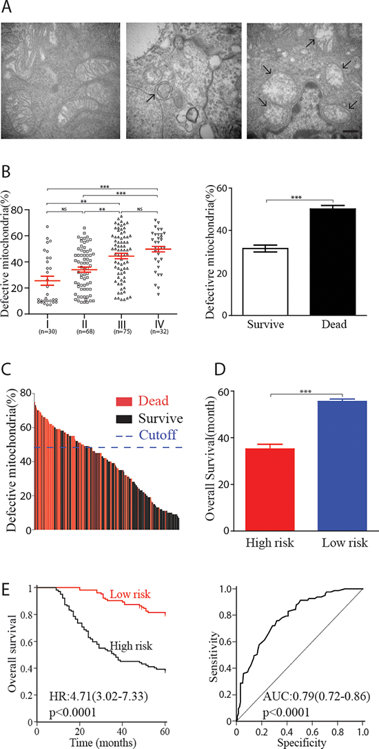 Defective mitochondria and clinical outcomes in human colorectal carcinoma.